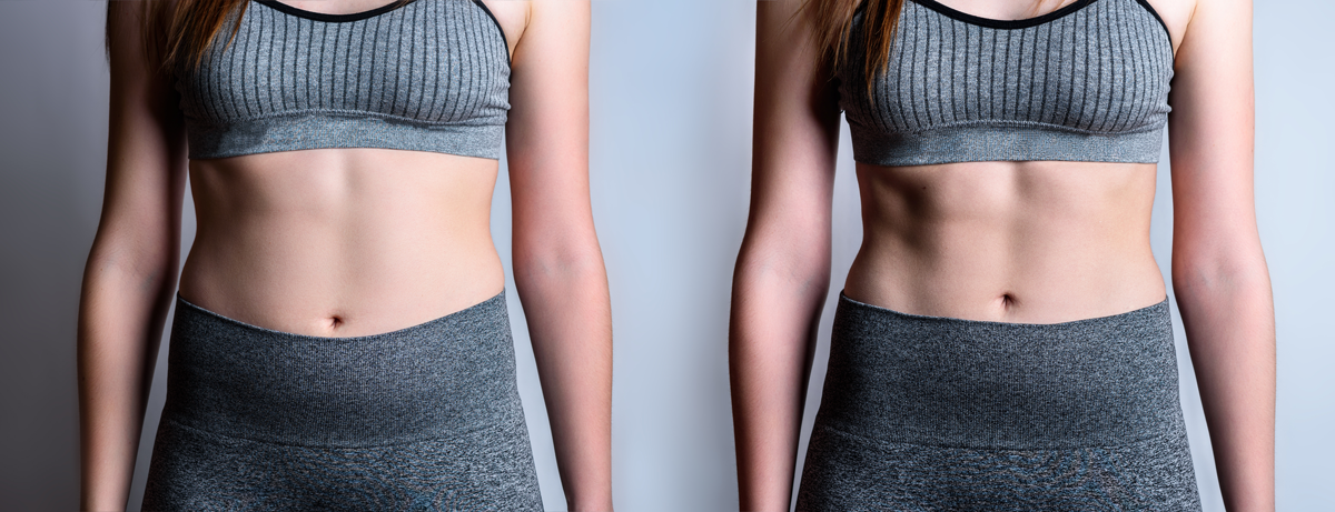 EmsculptBeforeandAfter wholesome health function medicine services